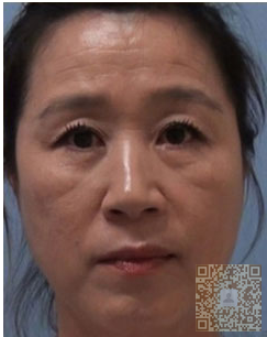 中年大妈出现婚姻危机，考做超 声 波提拉术，缓解危机。