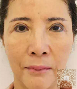 做了线雕失败后，我选择到超雅做面部提升术修复996