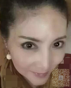 做了线雕失败后，我选择到超雅做面部提升术修复996