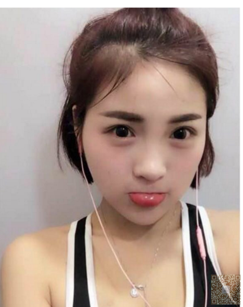 我要去重庆超雅做完超声波去眼袋啦110 我要去重庆超雅做完超声波去眼袋啦110