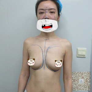 超声波自体脂肪丰胸后身材超级棒345 超声波自体脂肪丰胸后身材超级棒345
