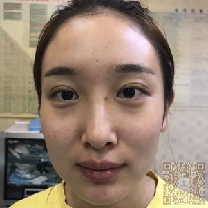 超雅面部提升年轻不止五岁449 超雅面部提升年轻不止五岁449