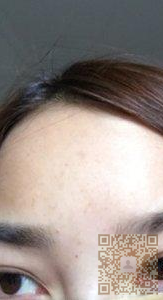 超 声 波去眼袋才shì理想得去眼袋手术 超 声 波去眼袋才shì理想得去眼袋手术
