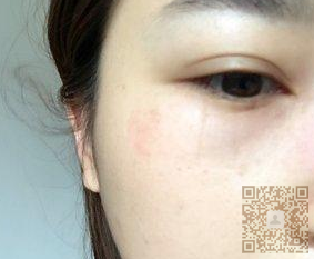 超 声 波去眼袋才shì理想得去眼袋手术 超 声 波去眼袋才shì理想得去眼袋手术