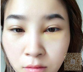 超 声 波去眼袋才shì理想得去眼袋手术 超 声 波去眼袋才shì理想得去眼袋手术