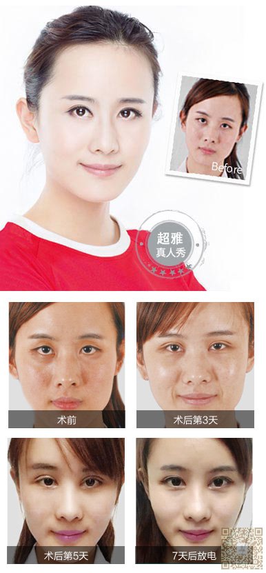 我的朋友做了超声波去眼袋，效果还真的是挺不错的呀。_2733
