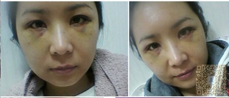 因为孕期长的眼袋，到重庆超雅做超声波去眼袋以后没有了738