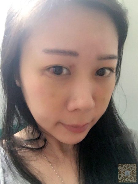 记录一下我去重庆超雅成功祛眼袋的过程吧941 记录一下我去重庆超雅成功祛眼袋的过程吧941