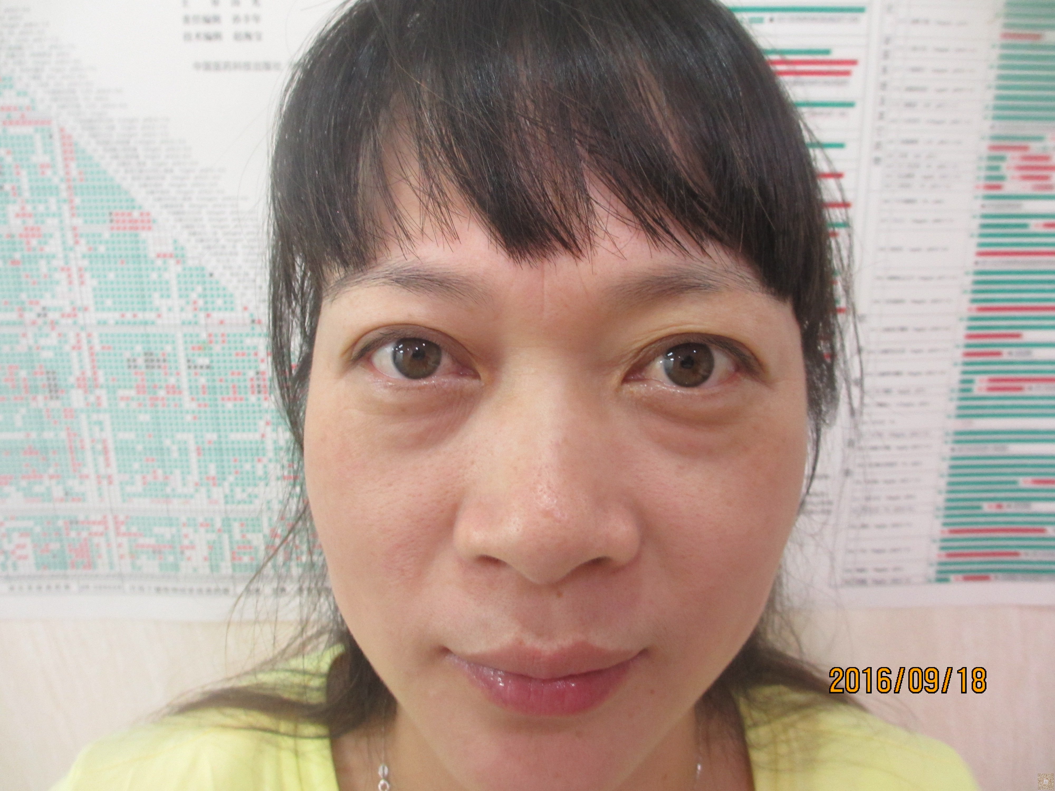 重庆超雅的超声波去眼袋的效果太明显了011 重庆超雅的超声波去眼袋的效果太明显了011