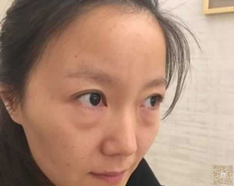 想要去眼袋,就必须得来到超雅做超 声 波去眼袋 想要去眼袋,就必须得来到超雅做超 声 波去眼袋