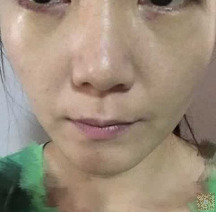 想要去眼袋,就必须得来到超雅做超 声 波去眼袋 想要去眼袋,就必须得来到超雅做超 声 波去眼袋