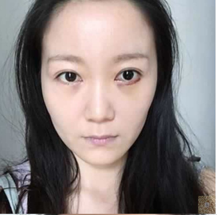 想要去眼袋,就必须得来到超雅做超 声 波去眼袋 想要去眼袋,就必须得来到超雅做超 声 波去眼袋