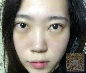 眼袋真心显老,还shì用超 声 波去眼袋 眼袋真心显老,还shì用超 声 波去眼袋