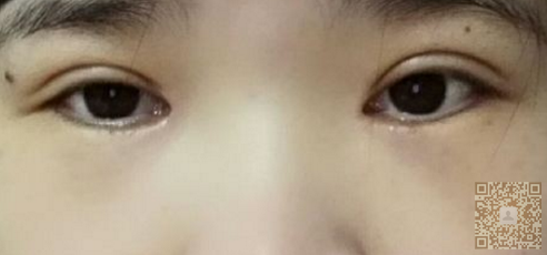 超声波双眼皮真的好用,非常棒306 超声波双眼皮真的好用,非常棒306