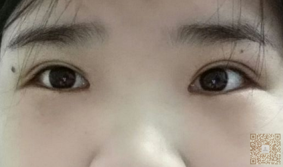 超声波双眼皮真的好用,非常棒306 超声波双眼皮真的好用,非常棒306