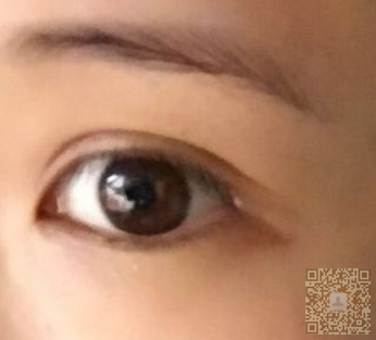 单眼 皮变双眼 皮什么方法实惠？当然shì超 声 波双眼 皮