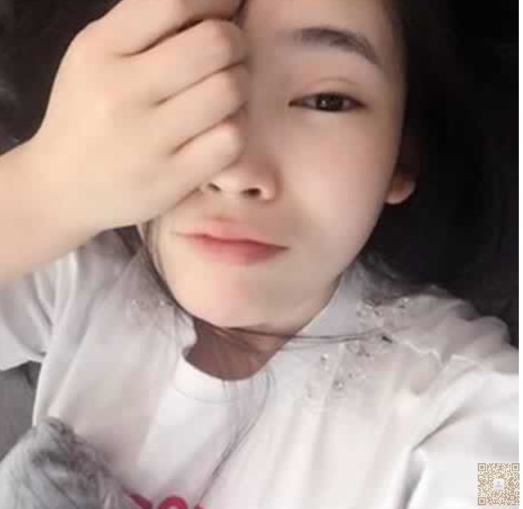 上网长的眼袋轻松祛除掉，就靠超雅超声波去眼袋904