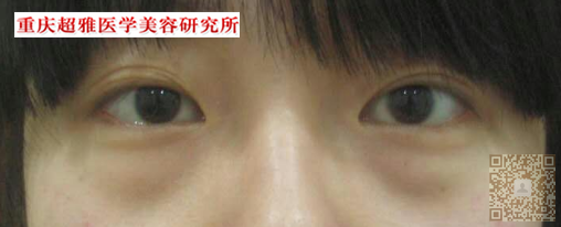 长眼袋就得到超雅去做超声波去眼袋手术990 长眼袋就得到超雅去做超声波去眼袋手术990
