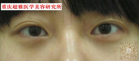长眼袋就得到超雅去做超声波去眼袋手术990 长眼袋就得到超雅去做超声波去眼袋手术990