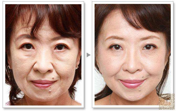 害怕衰老得女人，快来到重庆超雅医学美容研究所，做超 声 波提升术