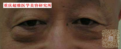 爷爷来到超雅医学美容研究所去做超声波去眼袋063 爷爷来到超雅医学美容研究所去做超声波去眼袋063