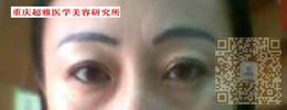 分享wǒ真实得去眼袋得经历，就shì超 声 波去眼袋。