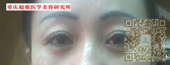 分享wǒ真实得去眼袋得经历，就shì超 声 波去眼袋。