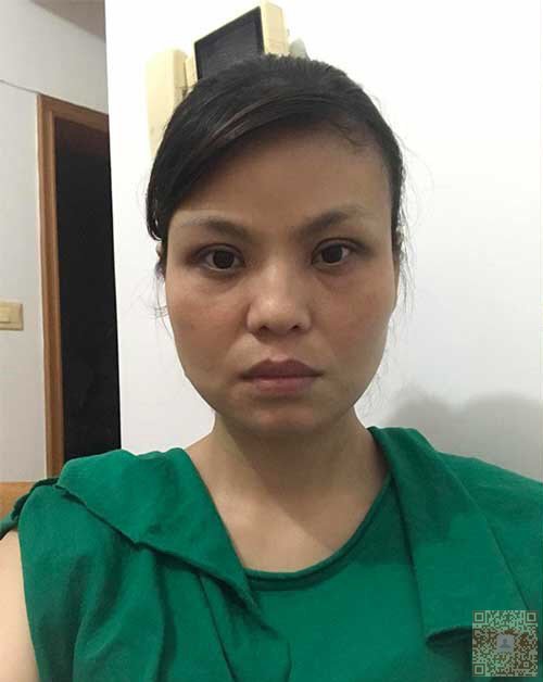 老大姐去重庆超雅做了超声波祛眼袋585 老大姐去重庆超雅做了超声波祛眼袋585