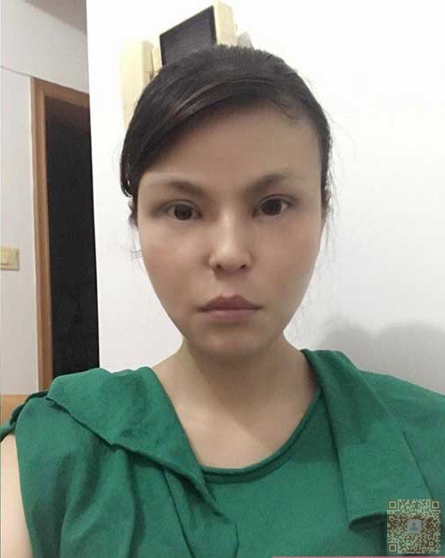 老大姐去重庆超雅做了超声波祛眼袋585 老大姐去重庆超雅做了超声波祛眼袋585