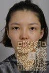 爱吃煎饼得wǒ做le超 声 波瘦脸，瘦出le可爱孝脸蛋