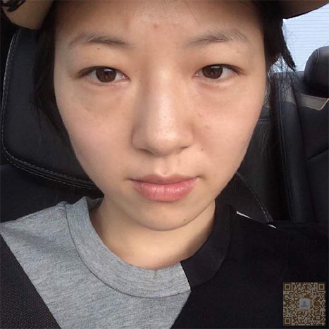 自由职业者长了眼袋怎么办？当然是到超雅做超声波祛眼袋啊328