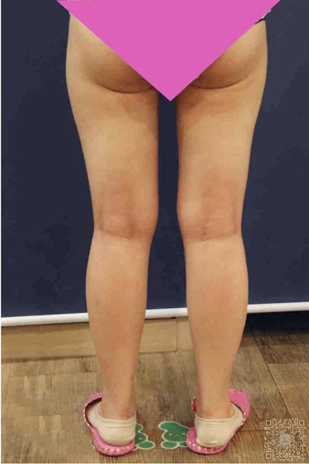 超声法减肥给自己ー个精致得机会 超声法减肥给自己ー个精致得机会