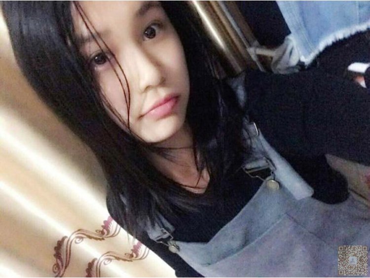我的超声波双眼皮经历记录526 我的超声波双眼皮经历记录526