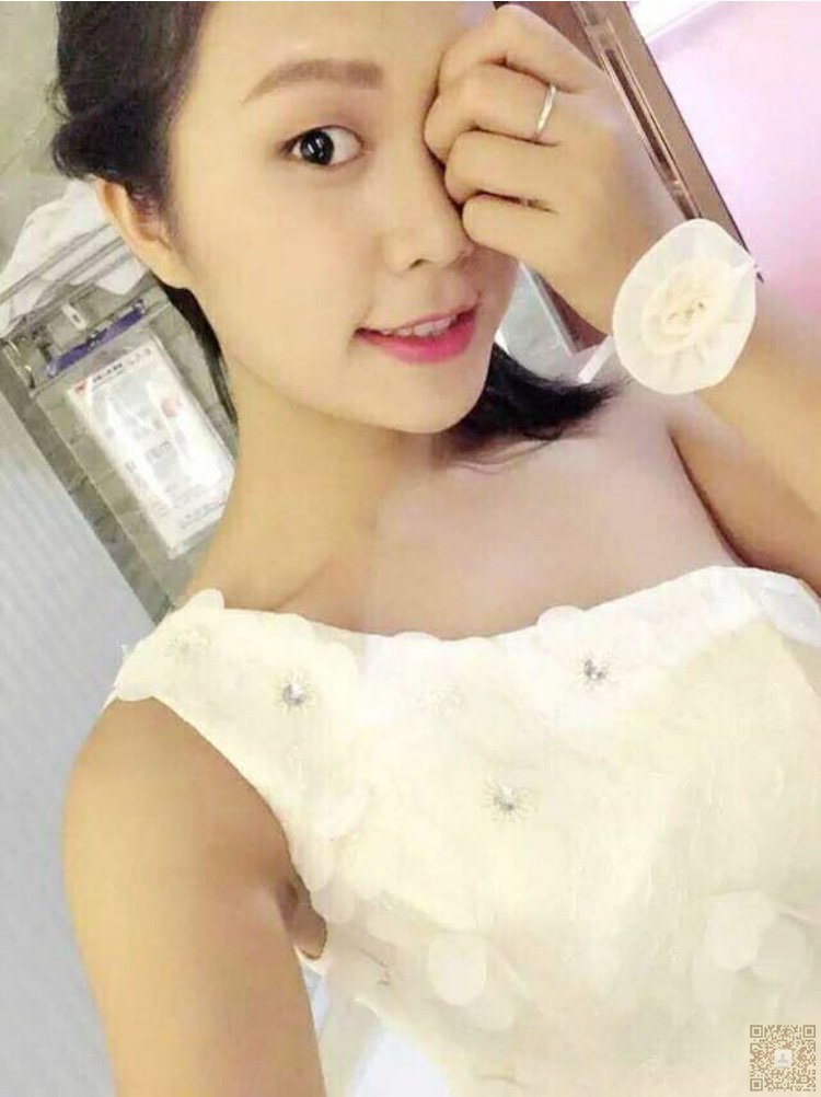 我的超声波双眼皮经历记录526 我的超声波双眼皮经历记录526