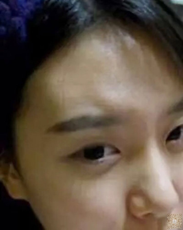 我的超声波双眼皮经历记录526 我的超声波双眼皮经历记录526