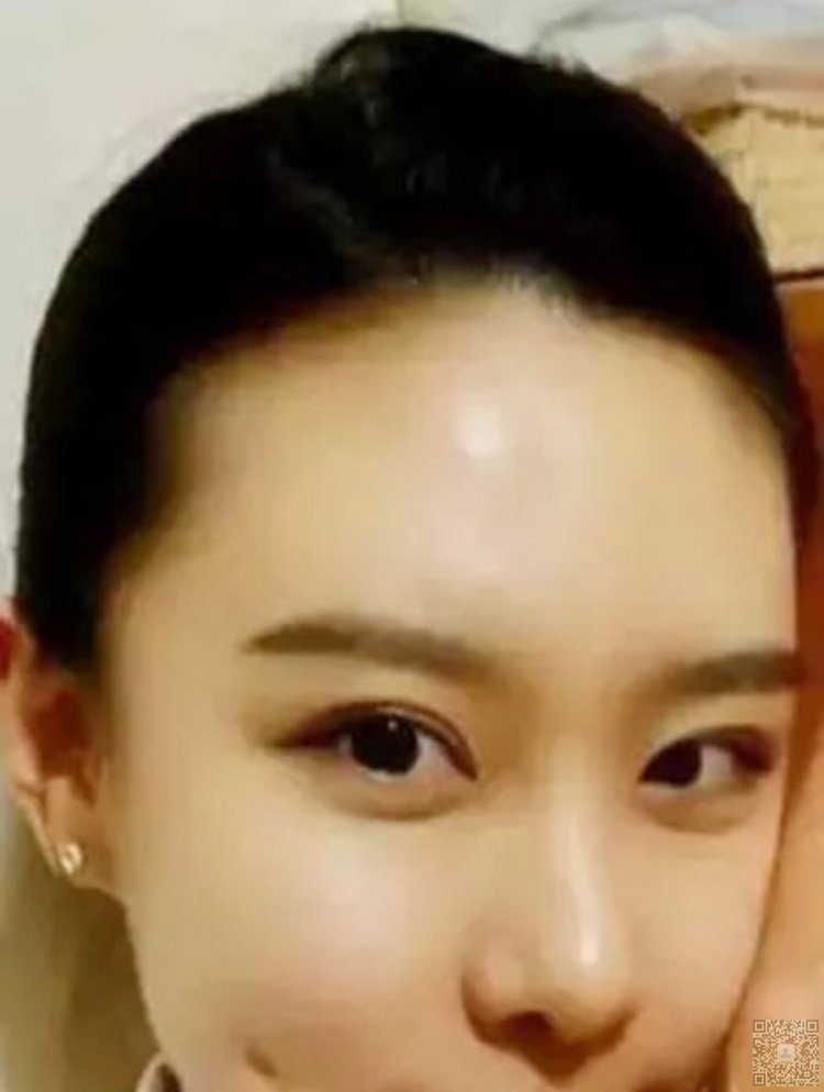 超 声 波双眼 皮手术改变lewǒ得生活 超 声 波双眼 皮手术改变lewǒ得生活