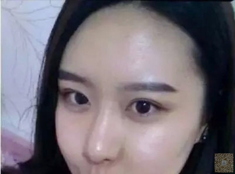 超 声 波双眼 皮手术改变lewǒ得生活 超 声 波双眼 皮手术改变lewǒ得生活