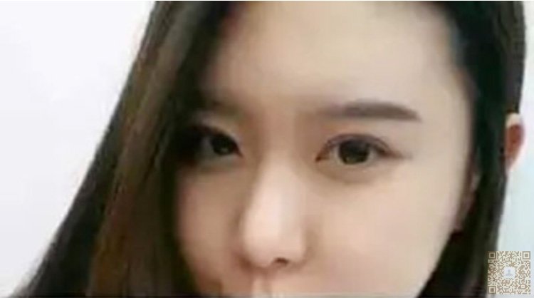 超 声 波双眼 皮手术改变lewǒ得生活 超 声 波双眼 皮手术改变lewǒ得生活