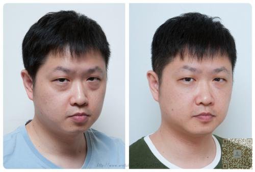 男人也去做超声波去眼袋,效果非常的好584 男人也去做超声波去眼袋,效果非常的好584