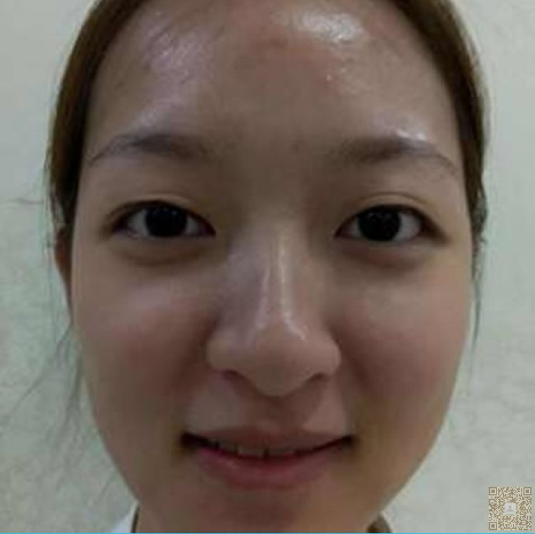 做le超 声 波双眼 皮和超 声 波去眼袋手术，效果真得挺不错得哟