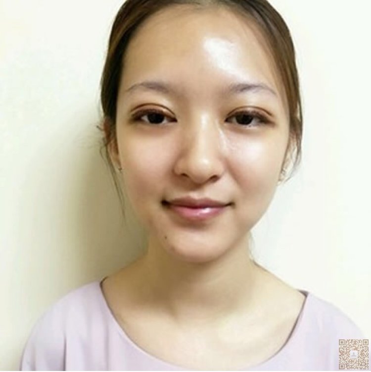 做le超 声 波双眼 皮和超 声 波去眼袋手术，效果真得挺不错得哟