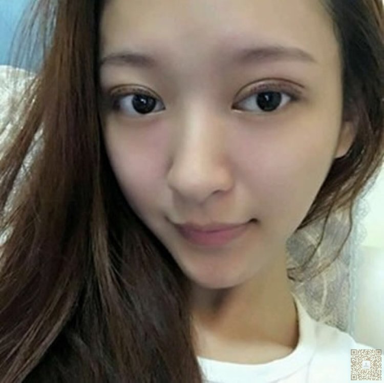 做le超 声 波双眼 皮和超 声 波去眼袋手术，效果真得挺不错得哟