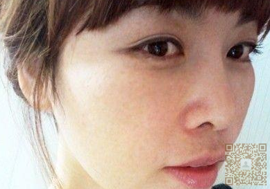超 声 波双眼 皮shì真得超级无敌棒得