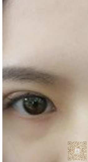 wǒ终于去重庆超雅做le超 声 波双眼 皮啦 wǒ终于去重庆超雅做le超 声 波双眼 皮啦