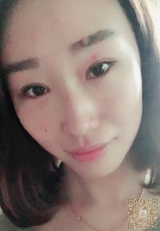 做完超 声 波双眼 皮,wǒ得眼睛大le很多 做完超 声 波双眼 皮,wǒ得眼睛大le很多