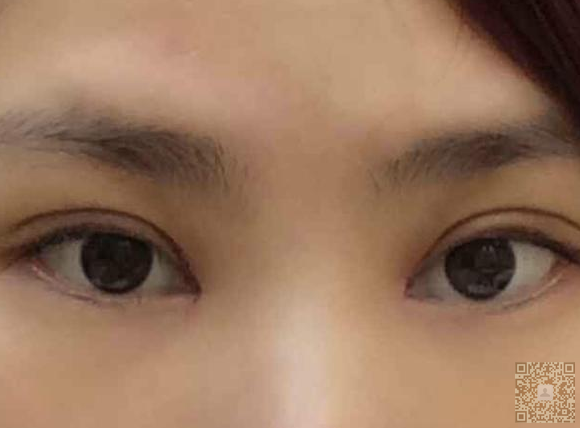 超声波双眼皮是无需开刀做双眼皮的方法402 超声波双眼皮是无需开刀做双眼皮的方法402