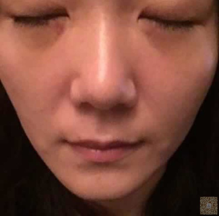 超 声 波祛眼袋效果有保障 超 声 波祛眼袋效果有保障