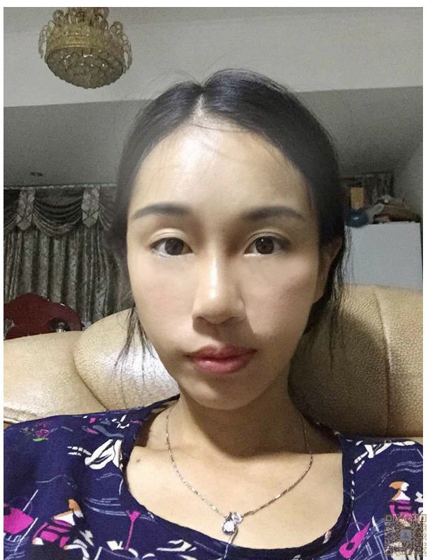 超 声 波祛眼袋有效缓解年龄尴尬 超 声 波祛眼袋有效缓解年龄尴尬