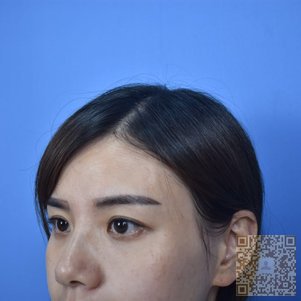 超声波双眼皮后变得好漂亮052 超声波双眼皮后变得好漂亮052