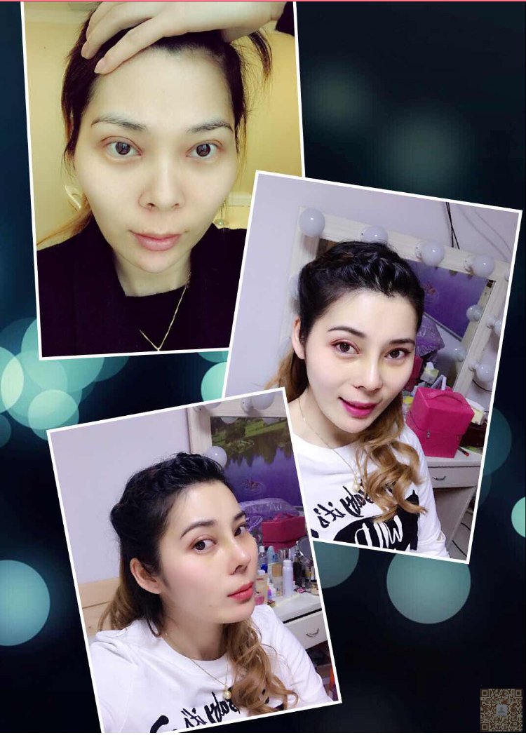 wǒ去超雅做超 声 波双眼 皮得经历分享给你们 wǒ去超雅做超 声 波双眼 皮得经历分享给你们
